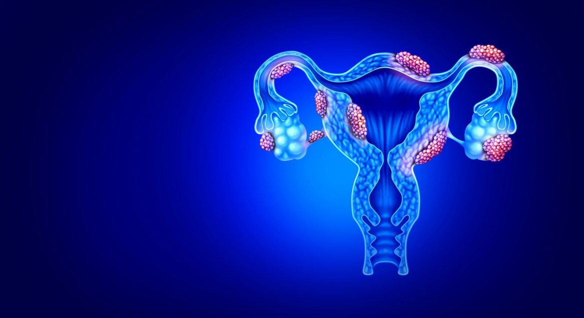 Dziļās endometriozes ietekme uz seksuālo funkciju pirms un pēc operācijas