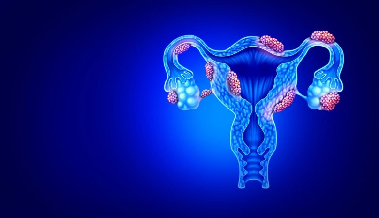 Gilios endometriozės
