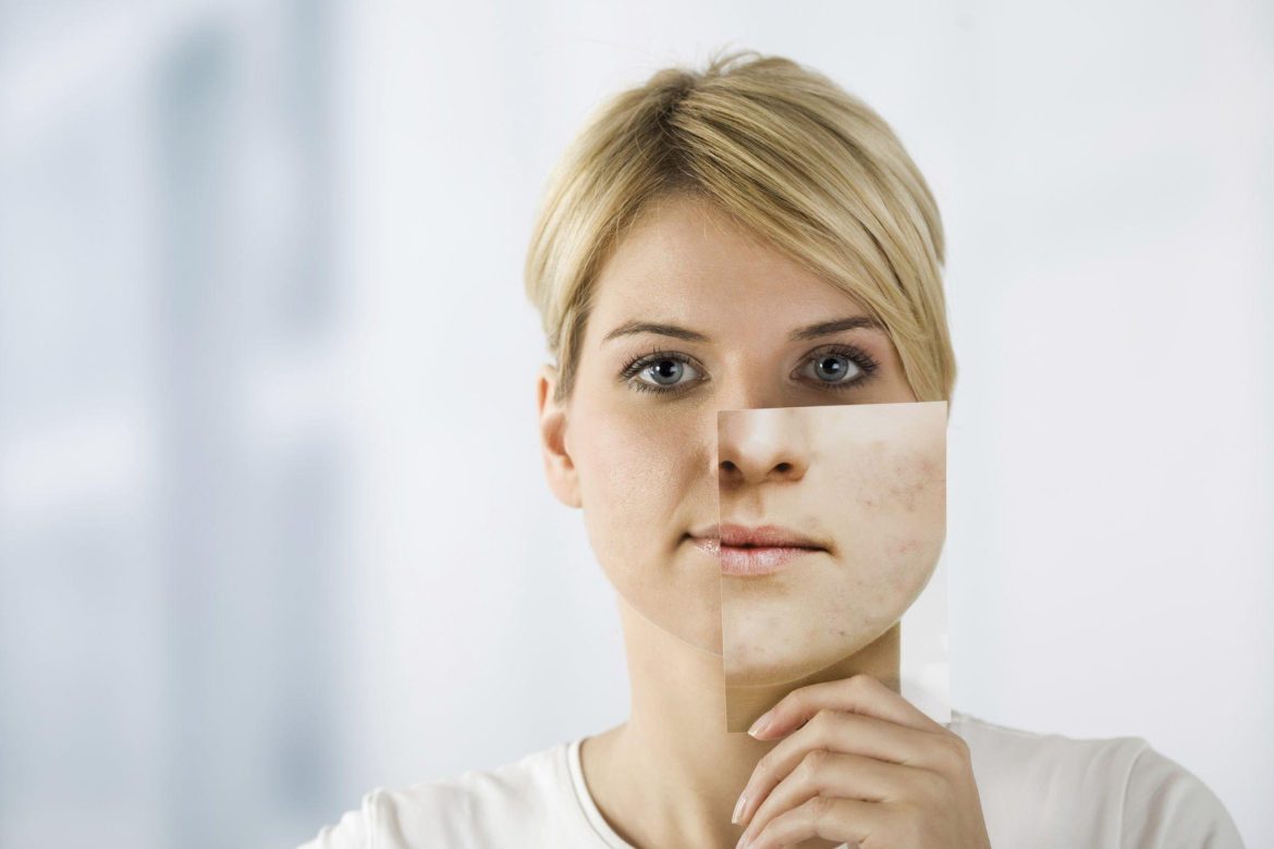 Tulkojums latviešu valodā, ņemot vērā terminoloģiju (medicīna, dermatoloģija):

Pinnes un herpess: izskats, simptomi un ārstēšana

**Piezīme:** Vārds spuogai lietuviešu valodā nozīmē “pinnes” vai “pumpas”; prieš herpesą šeit nozīmē “pretstatā herpesam”, t.i., salīdzinājums vai atšķiršana no herpes. Taču, respektējot latviešu valodas iekšējo loģiku un virsrakstu veidošanas stilistiku, vispiemērotākais būtu šāds variants:

**Pinnes vai herpess: atšķirības izskatā, simptomi un ārstēšanas iespējas**