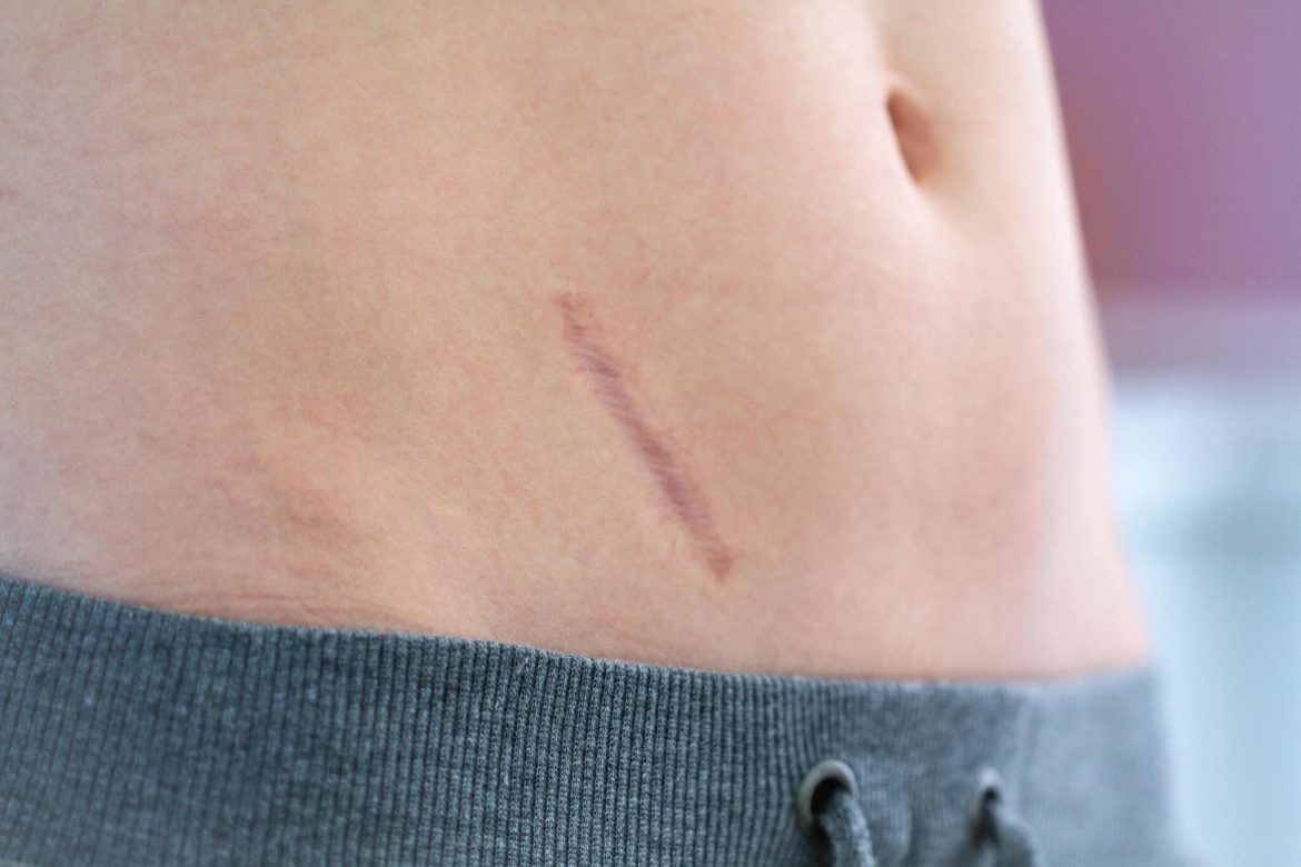 Tulkotais nosaukums latviešu valodā (medicīnas konteksts):

Operētās kuņģa slimības

Paskaidrojums:  
– “Operuoto” — operētas, t.i., ārstētas ķirurģiski;  
– “skrandžio” — kuņģa;  
– “ligos” — slimības.

Šo terminu lieto, apzīmējot kuņģa patoloģijas, kas radušās vai saglabājas pēc kuņģa operācijām (piemēram, pēc kuņģa rezekcijas).
