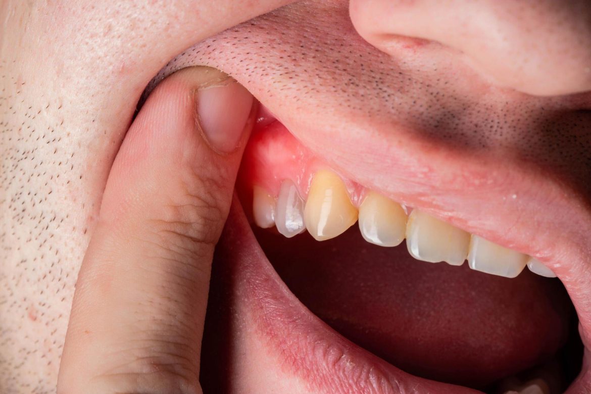 Danties cista latviešu valodā būtu: **zobkaula cista** vai **dentāla cista**.

Piezīme: Atkarībā no konteksta (stomatoloģija/odontoloģija) visbiežāk lietotie termini ir “zoba cista” vai “dentāla cista”, kas apzīmē cistu, kas saistīta ar zobiem vai to attīstību. Ja nepieciešams uzsvērt, ka tā ir zobu (nevis periapikāla vai citu formu) izcelsmes cista, piemērota ir “zobkaula cista” (no lat. dens – zobs), bet medicīniskajā apritē pārsvarā tiek lietots jēdziens “dentāla cista”.

**Ieteicamā versija:**
– dentāla cista
– zoba cista

Abas šīs formas ir pieņemtas latviešu medicīnas terminoloģijā.