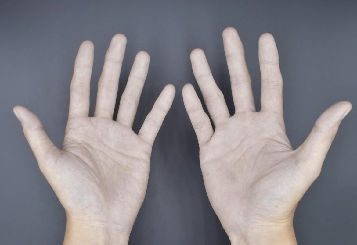Raynaud sindromas (lietuviešu valodā) tiek dēvēts par “Reino sindromu” (vai arī bieži – “Reino slimību”) latviešu valodā.

Pareizais latviskais nosaukums: **Reino sindroms** (vai arī, ja konteksts nosaka precīzāk, “Reino fenomens” vai “Reino slimība”).

Termins ir atzīts un plaši lietots latviešu medicīnas terminoloģijā.