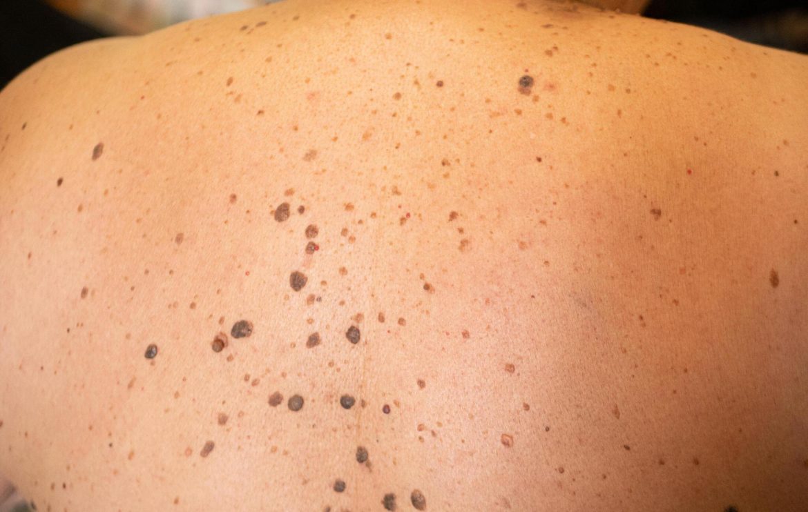 Nevi (apgaiņi)

Pamatojums:

– “Nevi” ir daudzskaitļa forma no latīņu “nevus”, ko medicīniski apzīmē ar “apgais” (vienskaitlī) vai “apgaiņi” (daudzskaitlī). Latviešu dermatoloģijā bieži izmanto abus variantus: apgais un apgaiņi, taču sarunvalodā tie bieži tiek dēvēti arī par “dzimumzīmēm” (plašākā nozīmē, kas var ietvert arī citus labdabīgus ādas veidojumus).
– Ja nepieciešams vairāk zinātnisks vai medicīnisks tonis (piemēram, ārstu dokumentācijā), vispareizāk ir lietot “apgaiņi”.
– Vajadzības gadījumā var norādīt abas formas, piemēram: **apgaiņi (nevi)**.

Tāpat, ja terminu lieto zinātniskā tekstā pirmo reizi, var uzrakstīt arī:  
**Apgaiņi (latīņu: nevi)**