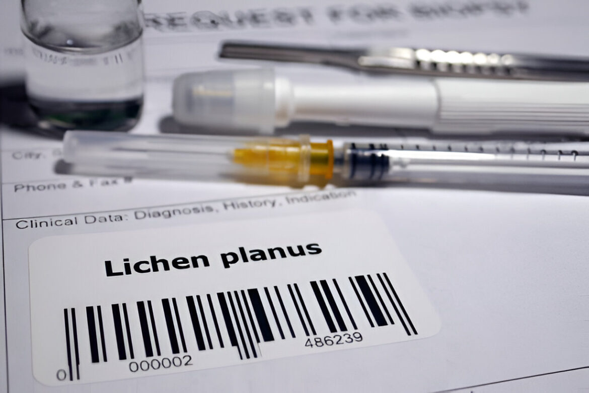 Medicīnas kontekstā lietuviešu termins “lytinių organų kerpligė” attiecas uz hronisku iekaisuma ādas slimību, kas konstatēta dzimumorgānu apvidū.

Latviski visprecīzākais un lietotākais termins ir:

**dzimumorgānu lichen planus**  
vai  
**dzimumorgānu plakanā ķērpja slimība**  

(Abi termini ir pieņemti medicīnas terminoloģijā, taču “lichen planus” bieži izmanto nemainot, savukārt “plakanā ķērpja slimība” ir aprakstošāks.)

**Rekomendētā versija:**  
**dzimumorgānu plakanā ķērpja slimība** (vai īsāk — **dzimumorgānu plakanie ķērpji**)