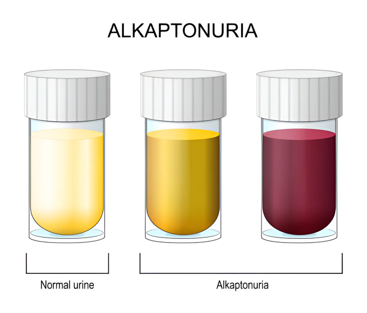 Alkaptonurija

Šis ir medicīnisks apzīmējums, kas arī latviešu valodā tiek lietots kā *alkaptonurija*. Termins ir starptautiski pieņemts un atbilst latviešu medicīnas terminoloģijai, tāpēc nav nepieciešams veidot citu tulkojumu vai aprakstošu nosaukumu.

**Atbilstošs variants:**  
alkaptonurija
