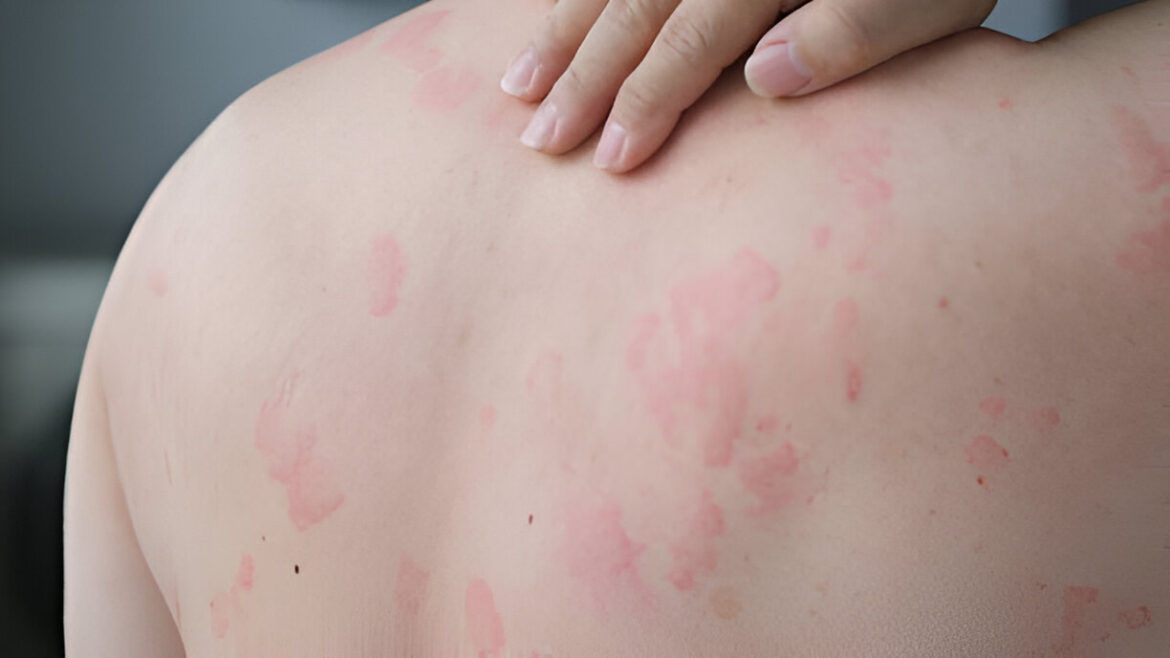 Nātrene: simptomi, cēloņi, ārstēšana