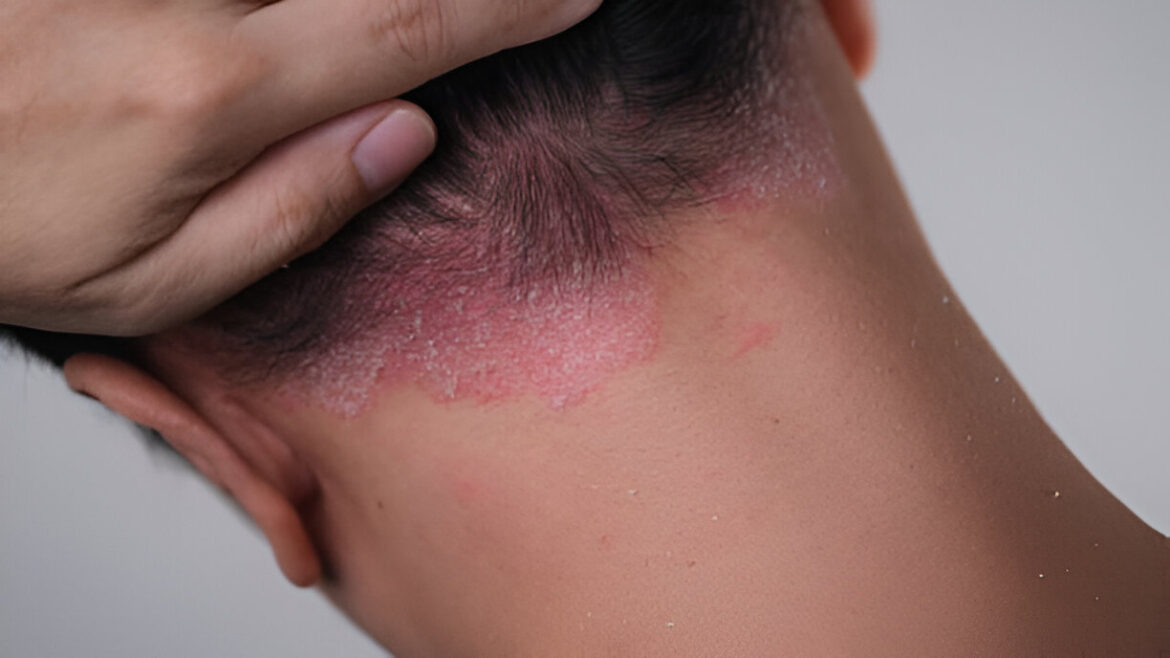 Seborejiskais dermatīts