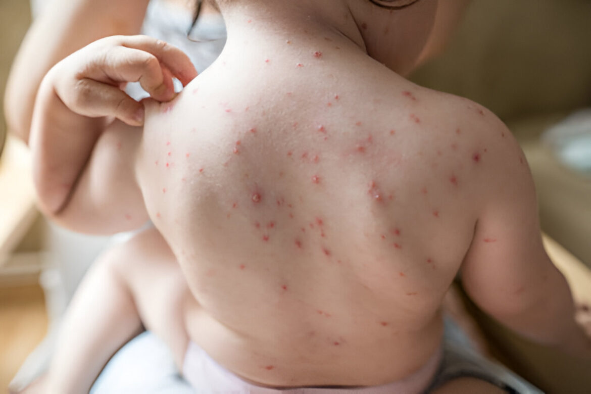 Latviski nosaukums **vėjaraupiai** (lietuviešu val.) tiek tulkots kā **vējbakas**.

**Pamatojums:**  
Tā ir vispārpieņemta un medicīniski korekta termina lokalizācija latviešu valodā.