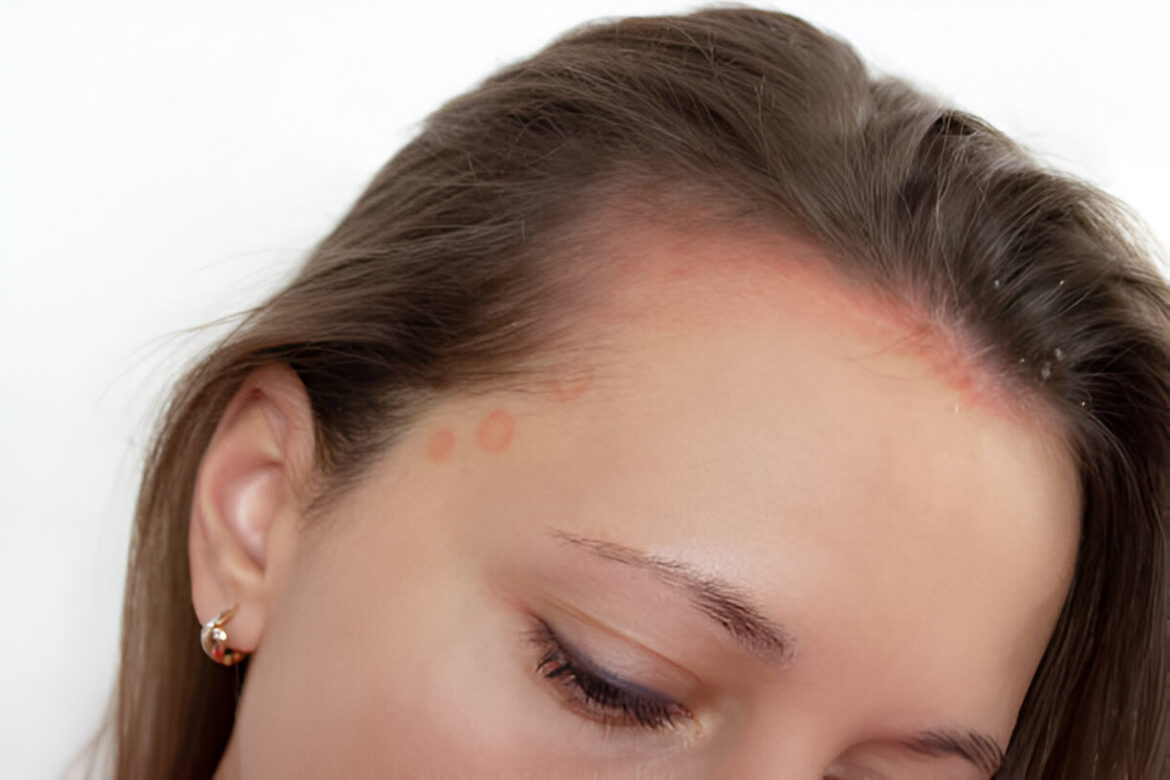 Psoriāze