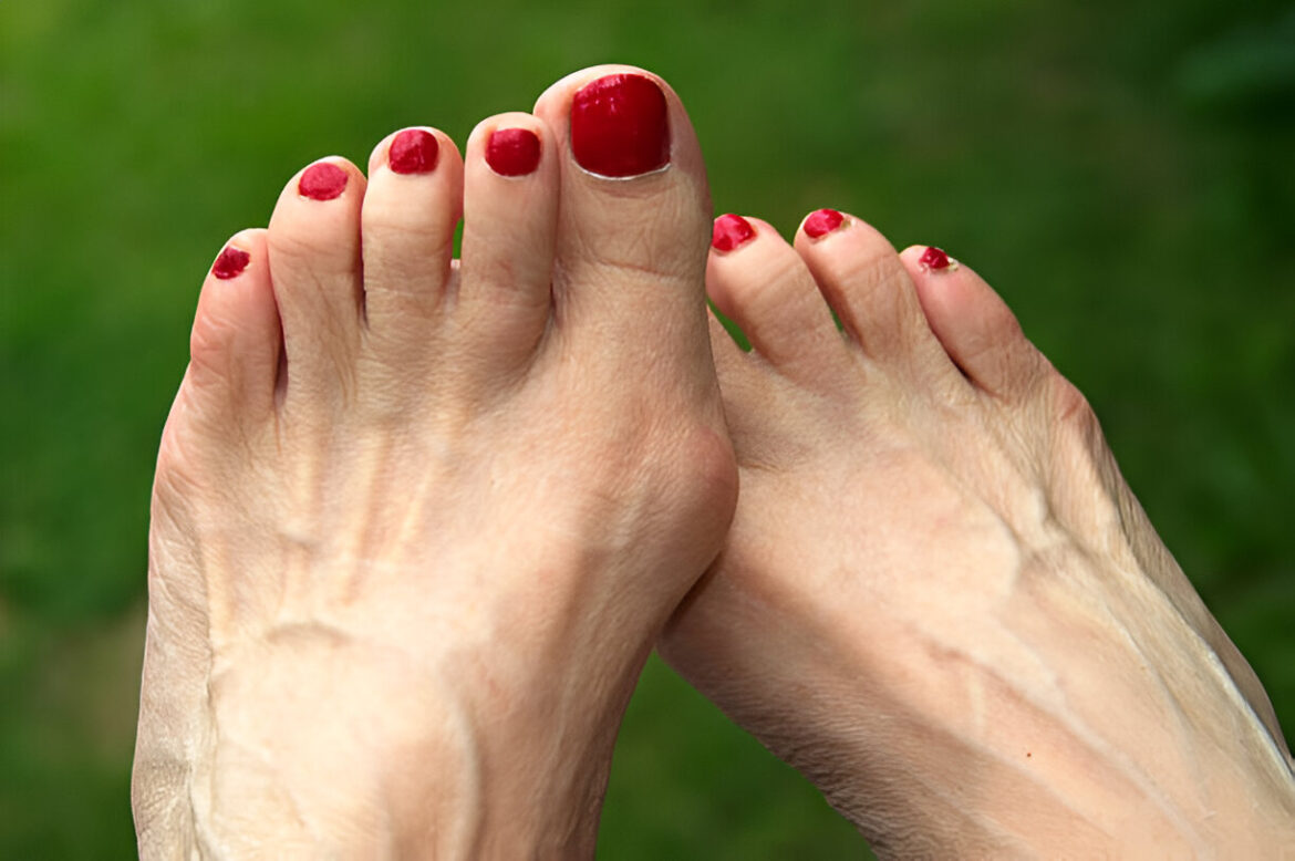 Halluks valgus: cēloņi, simptomi, ārstēšana un profilakse
