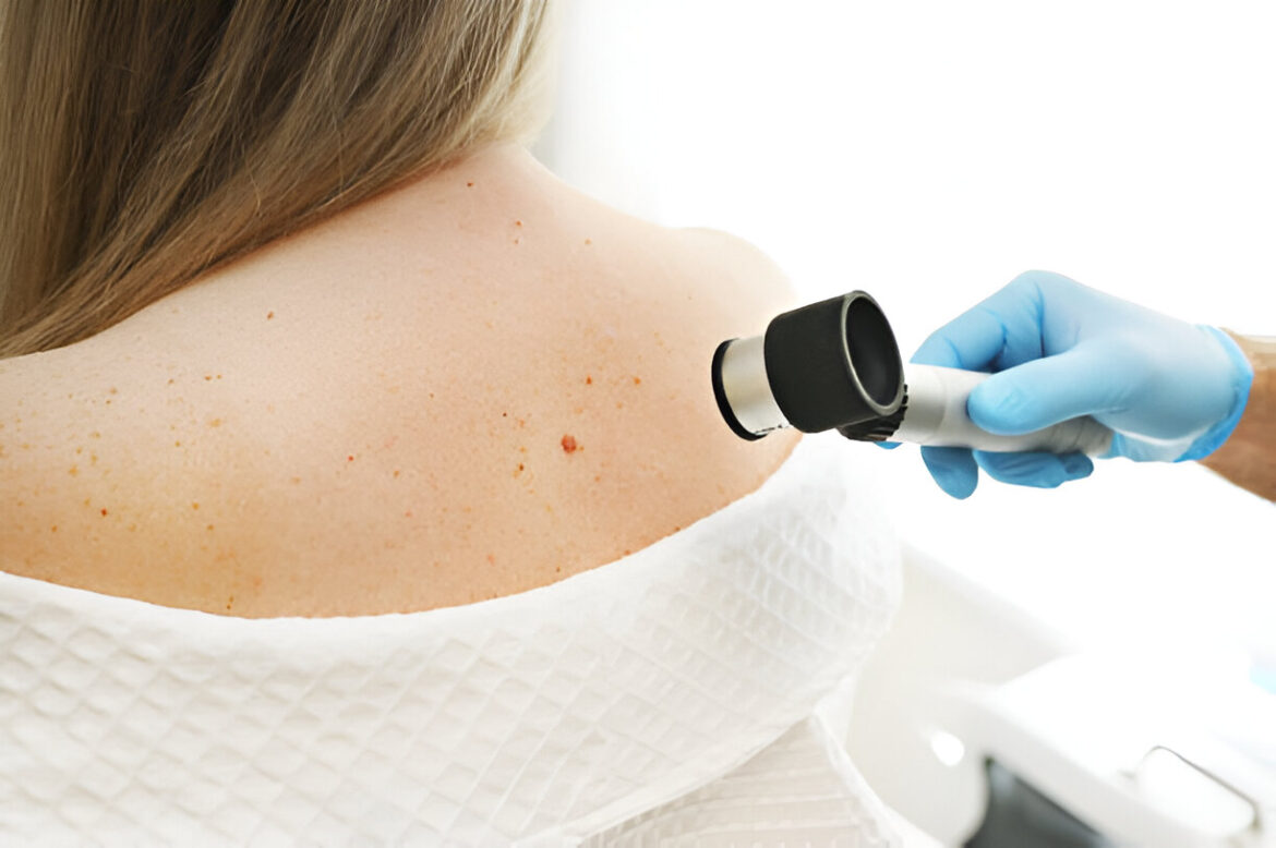 Melanoma: Cēloņi, simptomi un ārstēšana