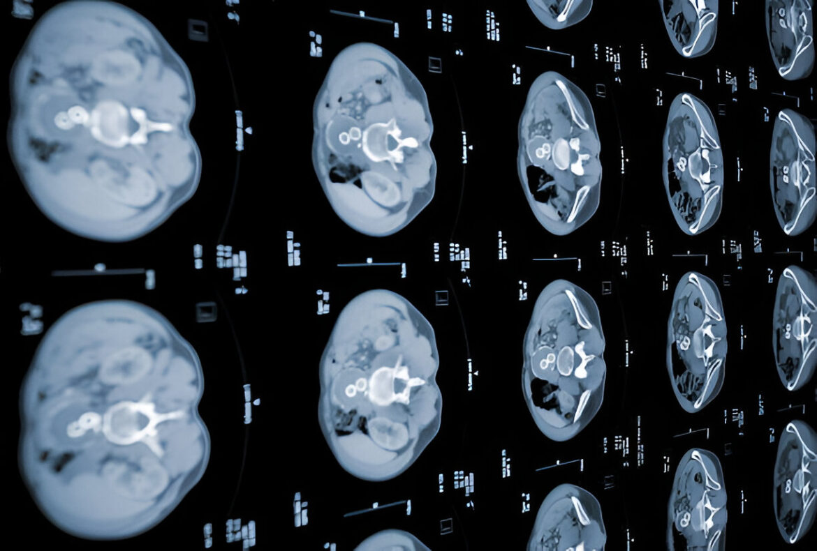 Smadzeņu arteriovenozo malformāciju simptomi un ārstēšana