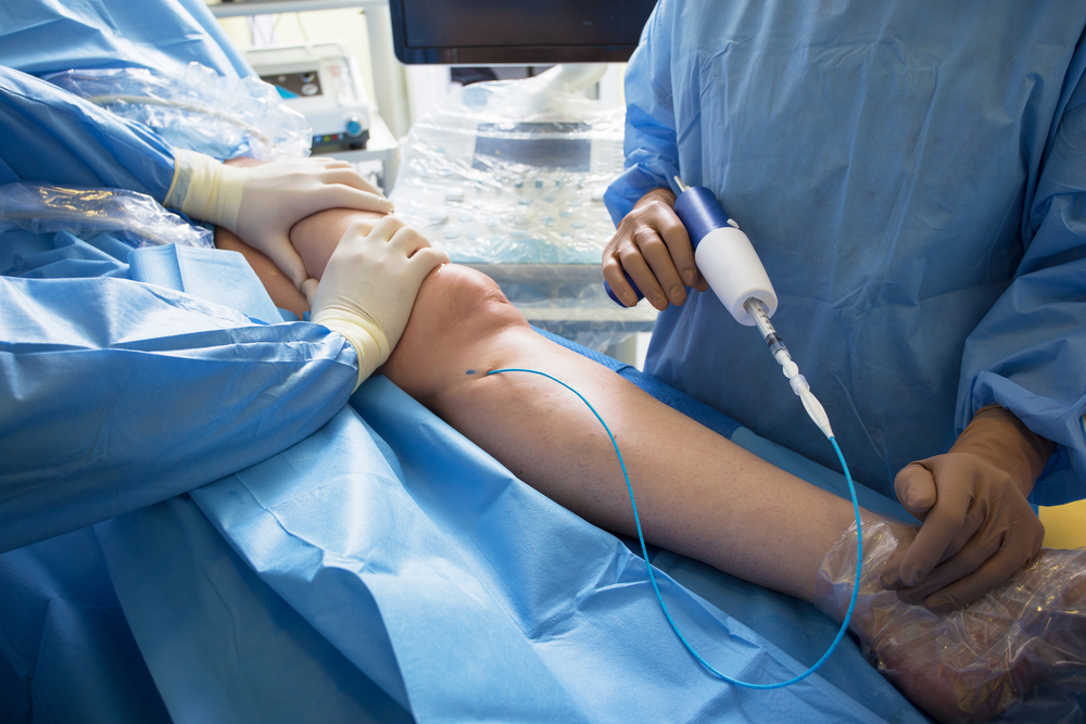 Tavs pieprasītais medicīniskais termins latviešu valodā tiek tulkots kā:

**Perkutāna koronārā intervencija (PKI)**

Vai arī pilnākais variants:

**Perkutāna koronārā intervence (PKI)**

Vairāk sarunvalodā bieži lieto arī:  
**Perkutāna koronārā angioplastija** (ja uzsvars uz procedūru, kas ietver balonu, nevis vispārīgu intervenču grupu).

Taču visbiežāk oficiālajos dokumentos un medicīnas praksē tiek lietots:  
**Perkutāna koronārā intervencija (PKI)**